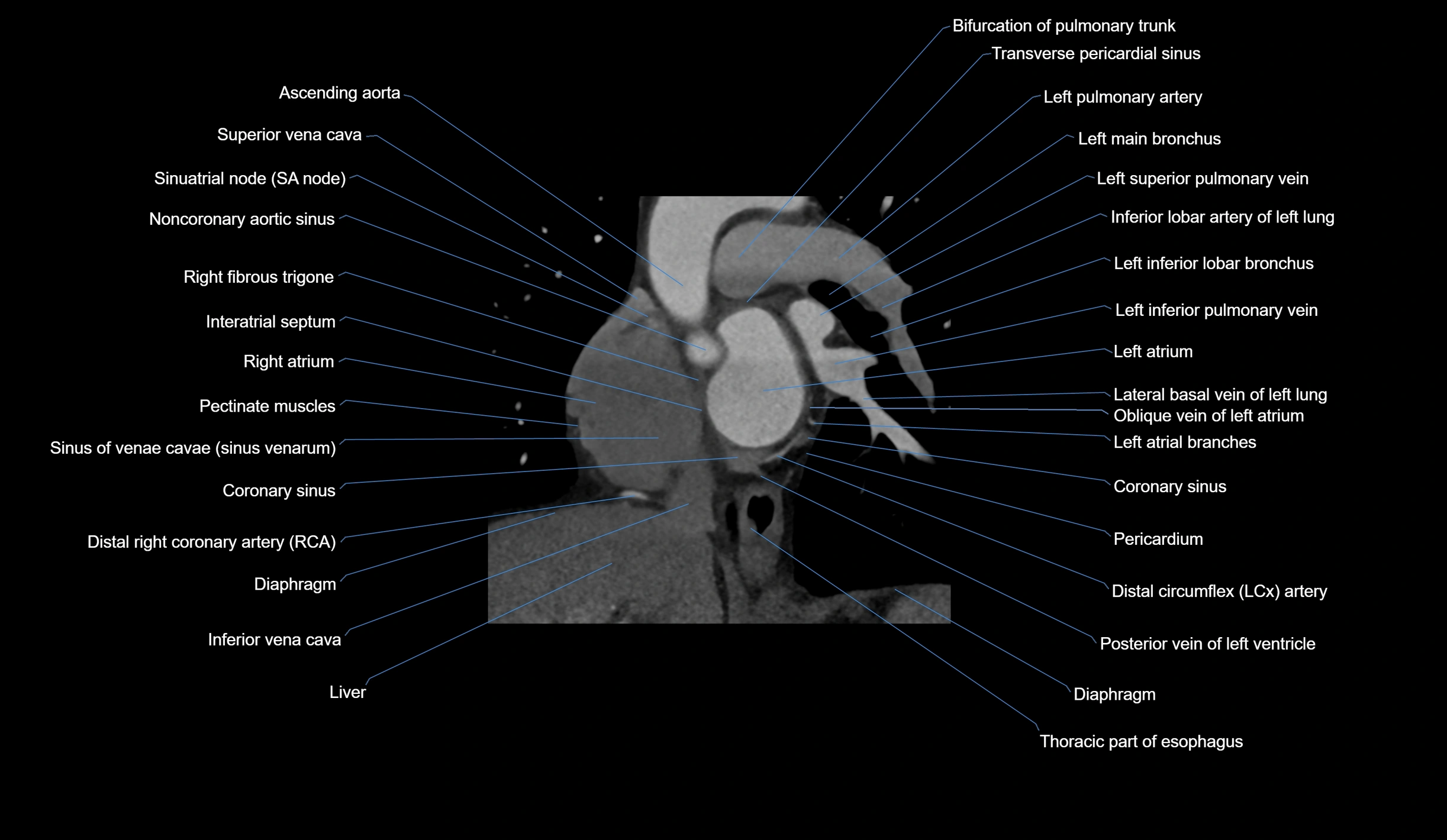 CT heart (coronary angiogram) short axis view  cross sectional anatomy labelled radiology image-00015.webp